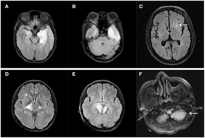 Recurrence of Anti-N-Methyl-D-Aspartate Receptor Encephalitis: A Cohort Study in Central China